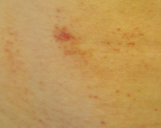 pinpoint red spots on the skin petechiae