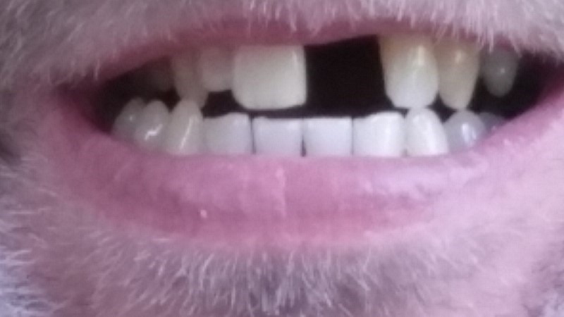 missing-tooth
