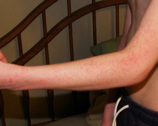 skin-rash